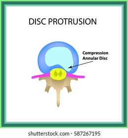 Disc protrusion. Top view. Spine. Infographics Vector illustration on isolated background