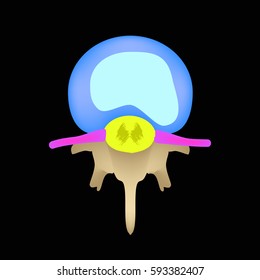 Disc protrusion. Top view. Spine. Infographics Vector illustration on a black background