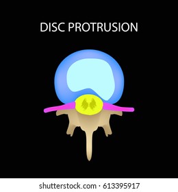 Disc protrusion. Top view. Spine. Infographics Vector illustration on a black background