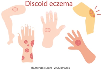 Discoid eczema,Nummular dermatitis. Discoid eczema is a chronic skin condition that causes skin to become itchy, swollen and cracked in circular or oval patches,Close-up of a Human's hand 