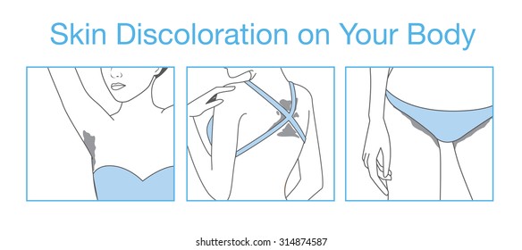 Decoloración de la piel en la parte del cuerpo después del bronceado o actividades al aire libre