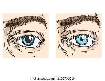 disease Anisocoria eyes types isolated on white background drawing 