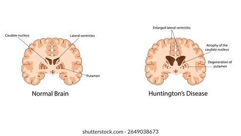 Ilustração do vetor da doença cerebral de Huntington