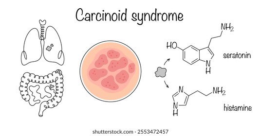 A disease caused by excessive secretion of serotonin and histamine due to the development of carcinoid, which most often occurs in the intestines and lungs. Vector illustration. Carcinoid syndrome.