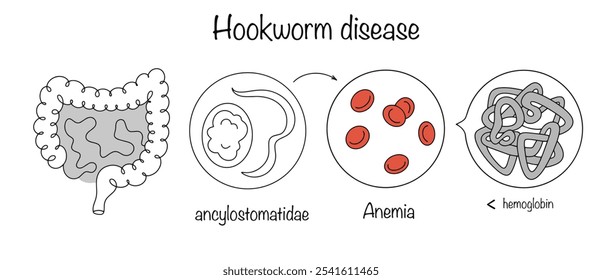 Enfermedad causada por ascárides que parasitan el intestino humano, lo que lleva al desarrollo de anemia. Diagrama dibujado a mano de la enfermedad. Ilustración vectorial.