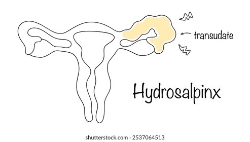 A disease of the fallopian tubes, manifested by the accumulation of fluid in the lumen of the organ. Color vector illustration on a white background. Medical vector on the theme of female diseases.