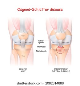 Osgood–Schlatter disease. Healthy Joint and Apophysitis of the tibial tubercle. Vector illustration. Poster for medical use