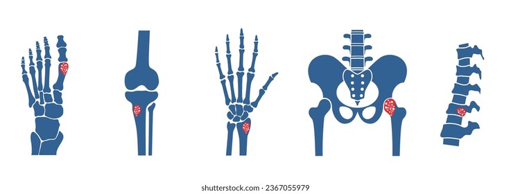 Enfermedad de los huesos y las articulaciones humanas. Espina inflamada, brazo, pierna y cadera. Trauma, lesión, infección o fracturas. Diagnóstico y tratamiento. Examen del cuerpo humano, cirugía y tratamiento del vector plano