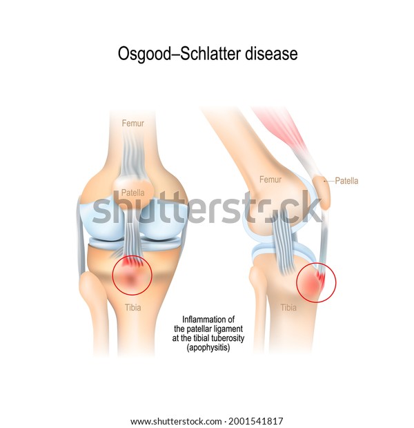 Osgood–Schlatter disease. inflammation of\
the patellar ligament at the tibial tuberosity. Anatomy of human\
knee (femur, patella, patellar ligament, tibia and fibula). vector\
illustration
