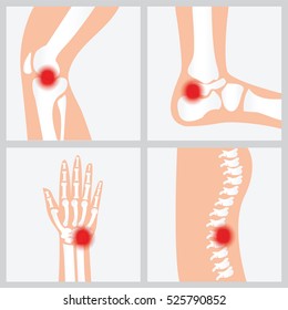 Disease of the joints and bones, medical health care flat vector illustration.