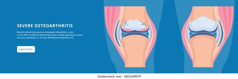 Disease of the knee joint. Osteoarthritis joint and healthy. Medical information banner with text. Healthy and unhealthy leg. Vector flat illustration