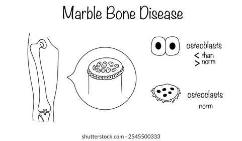 Doença manifestada por compactação de ossos ósseos e fragilidade óssea como resultado de um desequilíbrio entre osteoblastos e osteoclastos. Desenhou o diagrama da doença marmoreada. 