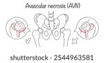 A disease of the musculoskeletal system, which is characterized by the destruction of the bone tissue of the head of the femur with impaired function of the hip joint. Simple vector illustration.