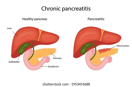 Disease Pancreatitis, Infographic. Liver And Pancreas. Vector Illustration In Cartoon Style.
