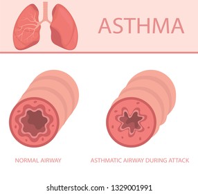 Disease of the pulmonary system. Illustration sthma-inflamed bronchial tube lungs and airways, normal and asthmatic. Vector illustration.