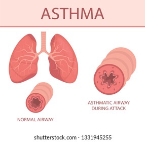 Disease of the pulmonary system. Illustration sthma-inflamed bronchial tube lungs and airways, normal and asthmatic. Vector illustration.
