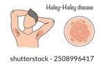 Hailey–Hailey disease. A rare disease characterized by recurrent rashes, predominantly located in the folds of the body. A man with a rash in the armpits. Dermatology vector.