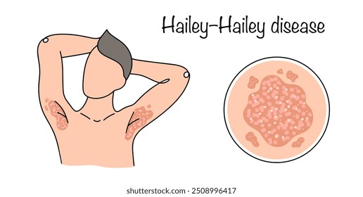 Hailey–Hailey disease. A rare disease characterized by recurrent rashes, predominantly located in the folds of the body. A man with a rash in the armpits. Dermatology vector.