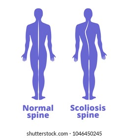 Disease of a spine. Scoliosis. Body posture defect. Blue human silhouettes isolated. Vector illustration.