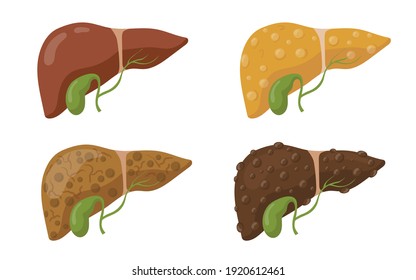 Estadios de enfermedad del hígado humano para el diseño web. Hígado de dibujos animados en diferentes condiciones aislado en la colección de ilustraciones de los vectores de fondo blanco. Concepto de salud y biología