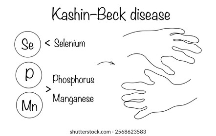 A disease that occurs as a result of a deficiency of selenium and an excess of phosphorus and manganese in the body. Causes osteoarthritis. Vector illustration. Kashin–Beck disease.