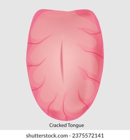Disease of the tongue, cracks. medical illustration, health sign vector,  Man or Woman,