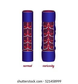 Disease varicose veins. Comparing normal veins and varicose veins. Vector illustration.