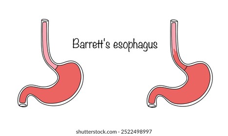 Enfermedad en la que un área del epitelio escamoso del esófago es reemplazada por un epitelio columnar metaplásico, que recuerda a la mucosa gástrica. Esófago sano y esófago con enfermedad.