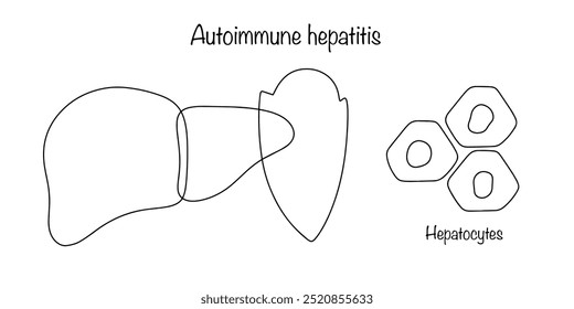 Enfermedad en la que el propio sistema inmunitario del cuerpo ataca el hígado y hace que se inflame. El sistema inmunitario protege al hígado de sus propias células sanas. Vector médico dibujado a mano.