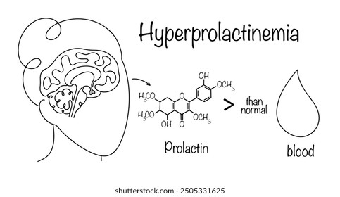 Enfermedad en la cual el nivel de la hormona prolactina en la sangre es significativamente más alto que los valores normales. La glándula pituitaria produce prolactina, que entra en la sangre. Ilustración simple.