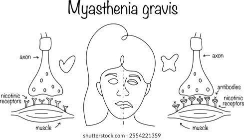 A disease in which the transmission of impulses from motor nerve endings to muscles is disrupted. Drawn myasthenia gravis and its manifestation on the face. Isolated vector on white background.