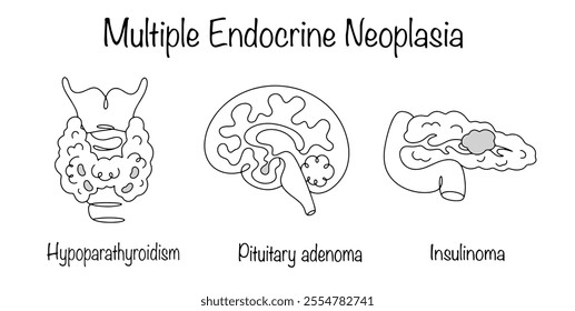 A disease in which tumors develop in several endocrine glands or the glands grow rapidly without forming tumors. Drawings of the main glands that are affected in multiple endocrine neoplasia.