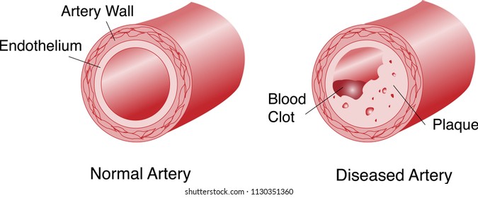 810 Blood vessels damage vector Images, Stock Photos & Vectors ...