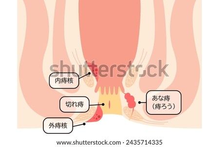 Diseases of the anus, cross-sectional view - Translation: hemorrhoids, warts, cut hemorrhoids, anorectal hemorrhoid