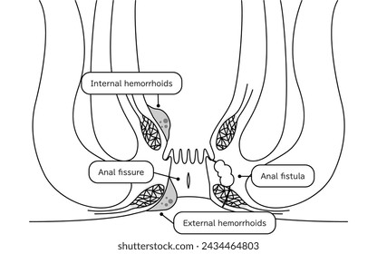 Diseases of the anus, hemorrhoids, warts, cut hemorrhoids, anorectal hemorrhoids Illustration, cross-sectional view - Translation: , warts, cut , anorectal hemorrhoids