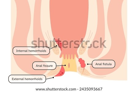Diseases of the anus, hemorrhoids, warts, cut hemorrhoids, anorectal hemorrhoids Illustration, cross-sectional view - Translation: hemorrhoids, warts, cut , anorectal 