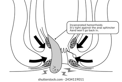 Erkrankungen des Afters, Hämorrhoiden und Warzen "Passende Hämorrhoiden" Illustration, Querschnitt - Übersetzung: Eingeführte Hämorrhoiden, durch den analen Schließmuskel gespannt und kehrt nicht zurück
