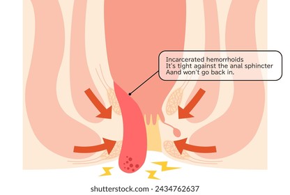Diseases of the anus, hemorrhoids and warts "Fitting hemorrhoids" Illustration, cross-sectional view - Translation: Inserted hemorrhoids, Tightened by the anal sphincter muscle and does not return