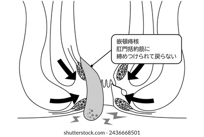 Enfermedades del ano, hemorroides y verrugas "Hemorroides que encajan" Ilustración, vista transversal - Traducción: Hemorroides insertadas, tensado por el músculo del esfínter anal y no regresa