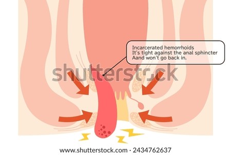 Diseases of the anus, hemorrhoids and warts "Fitting hemorrhoids" Illustration, cross-sectional view - Translation: Inserted hemorrhoids, Tightened by the anal sphincter muscle and does not return