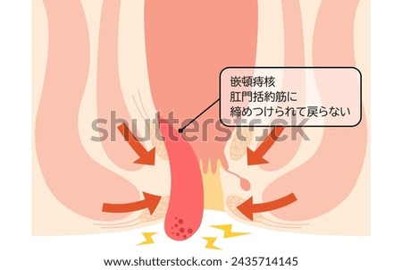 Diseases of the anus, hemorrhoids and warts "Fitting hemorrhoids" Illustration, cross-sectional view - Translation: Inserted hemorrhoids, Tightened by the anal sphincter muscle and does not return