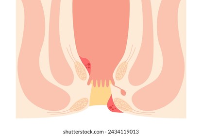 Diseases of the anus, hemorrhoids and warts Illustrations, cross-sectional views, Vector Illustration