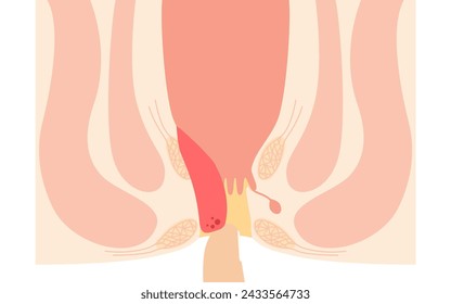 Diseases of the anus, hemorrhoids and warts "Internal hemorrhoids, degree III" Illustration, cross-sectional view, Vector Illustration