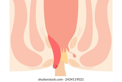 Enfermedades del ano, hemorroides y verrugas "Hemorroides internas, grado IV" Ilustración, vista transversal, ilustración vectorial
