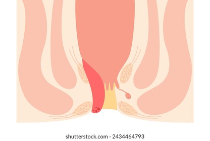 Diseases of the anus, hemorrhoids and warts "Internal hemorrhoids, degree II" Illustration, cross-sectional view, Vector Illustration