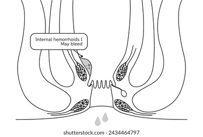 Diseases of the anus, hemorrhoids and warts "Internal hemorrhoids, degree I" Illustration, cross-sectional view - Translation: Internal hemorrhoids, degree I, may bleed