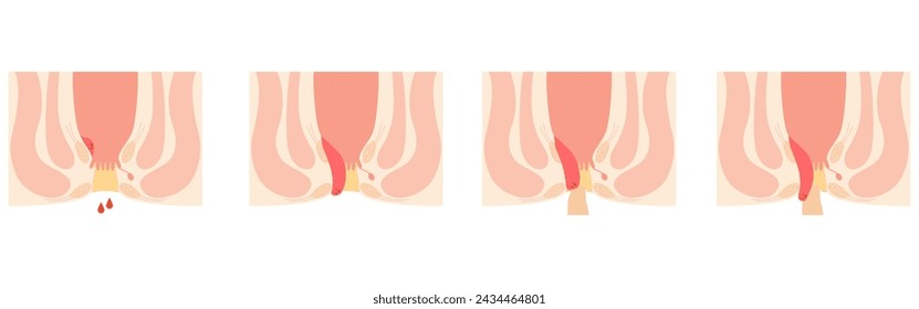 Diseases of the anus, hemorrhoids and warts "Internal hemorrhoids I-IV degree" Illustration, cross-sectional view, Vector Illustration
