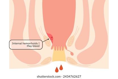 Enfermedades del ano, hemorroides y verrugas "Hemorroides internas, grado I" Ilustración, vista transversal - Traducción: Hemorroides internas, grado I, pueden sangrar
