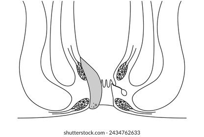 Enfermedades del ano, hemorroides y verrugas "Hemorroides internas, grado II" Ilustración, vista transversal, ilustración vectorial