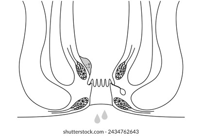 Diseases of the anus, hemorrhoids and warts "Internal hemorrhoids, degree I" Illustration, cross-sectional view, Vector Illustration